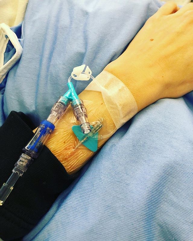Week 5 of Cervical Cancer Treatments